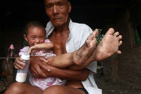 دختری که پاهایش شبیه دستانش است