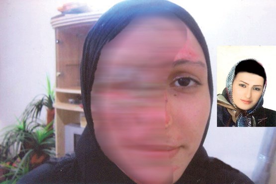 زندان، تبعید و دیه، مجازات اسیدپاشی روی 2 خواهر + عکس