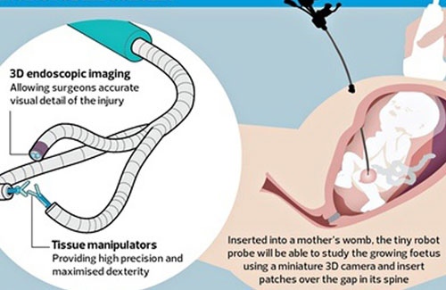 جراحی جنین در ۶ هفتگی