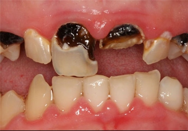 درمان ارزان و بی‌درد مشکلات دندان+تصاویر