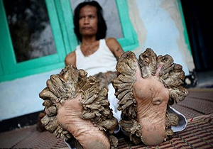 رشد درختی دست و پاهای مرد بنگلادشی