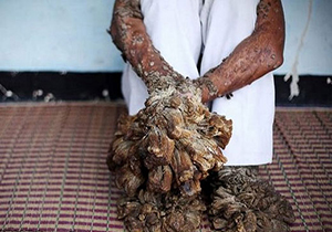 رشد درختی دست و پاهای مرد بنگلادشی
