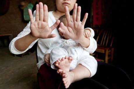 این کودک 31 انگشت دارد