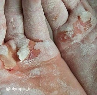 تصویری از دست&zwnj;های پینه بسته وزنه&zwnj;بردار تیم ملی