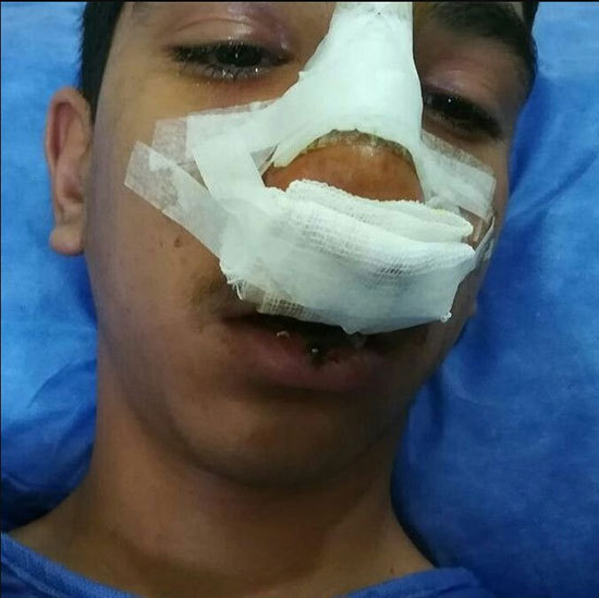 پیوند موفق پاهای قطع شده کودک ۲ ساله پیوند موفق پاهای قطع شده کودک ۲ ساله