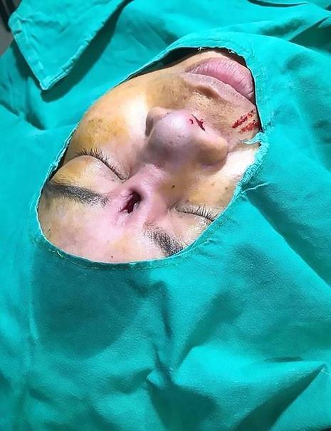 ترسناک&zwnj;ترین عارضه جانبی جراحی زیبایی بینی