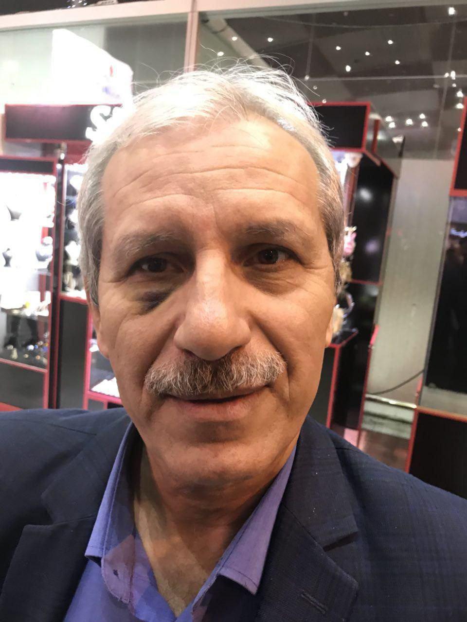 واکنش نصیرزاده به کبودی عجیب زیرچشمش واکنش نصیرزاده به کبودی عجیب زیرچشمش