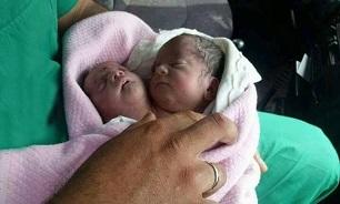 تولد نوزاد دو سر در سوریه