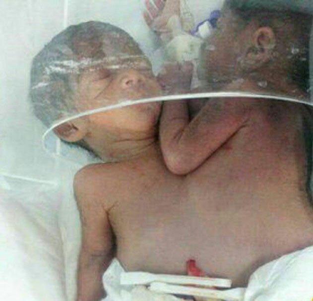 تولد دوقلوهای به‌هم‌چسبیده در نیکشهر