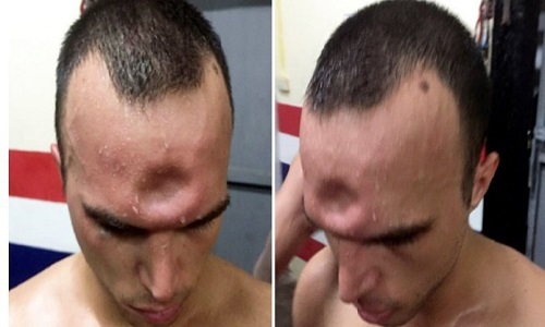 ضربه&zwnj;ای وحشتناک که جمجمه ورزشکار را شکست