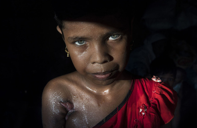 آزیدا دختر یازده ساله روهینگیایی که مادرش توسط ارتش میانمار کشته شد و خودش هم از ناحیه زیر بغل و پشت پا هدف گلوله قرار گرفت.