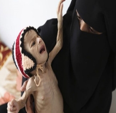 الإعلام الأعور يركز على طفل سقط في بئر ويتعامى عن أطفال اليمن