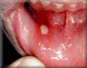 دلایل بروز آفت دهانی چیست؟ - تابناک | TABNAK