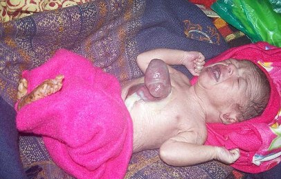 تولد نوزاد هندی با قلب خارج از بدن