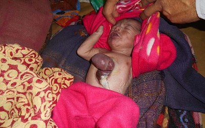 تولد نوزاد هندی با قلب خارج از بدن