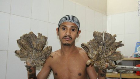 مرد درختی بنگلادشی جراحی شد