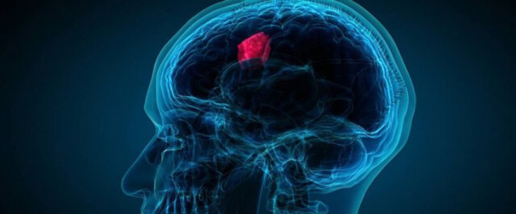 تشخیص تومور مغزی با یک آزمایش ساده - تابناک | TABNAK