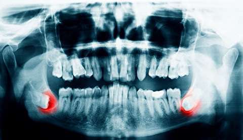 چرا دندان‌های عقل مشکل ساز هستند؟