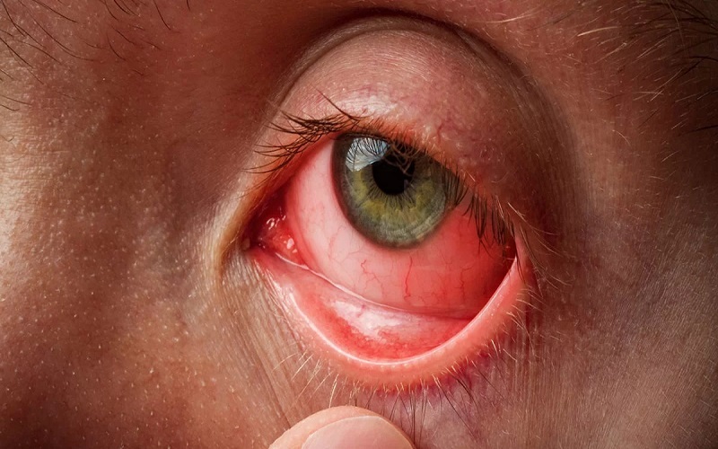 در مورد علل و عوامل عفونت چشم چه می‌دانید؟