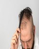 8 اشتباهی که در کاشت مو ناموفق نقش اساسی دارند