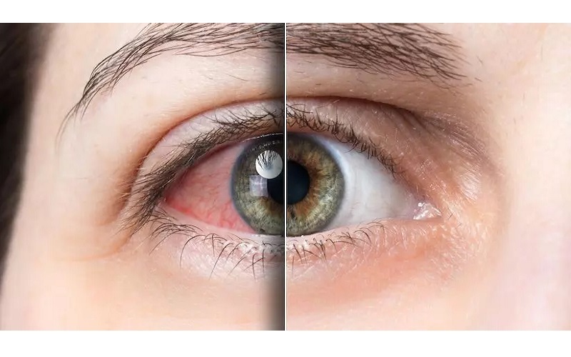 چند نکته مهم در مورد خشکی چشم و درمان آن