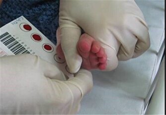 دستاورد درخشان یک غربالگری سراسری؛ نجات بیش از ۴ هزار کودک در هر سال