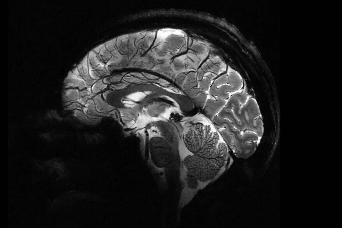 نخستین تصاویر مغزی ثبت‌شده توسط قوی‌ترین دستگاه MRI جهان