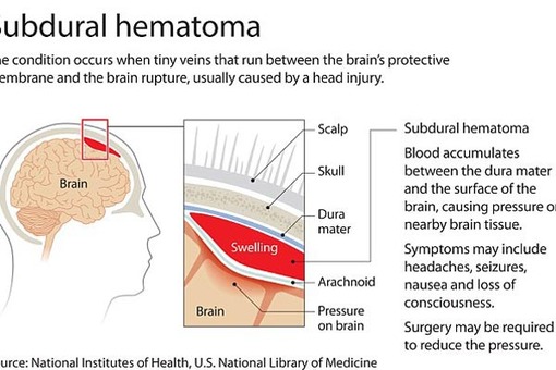 در این تصویر محل دقیق لخته خون در مغز شوماخر نمایان است