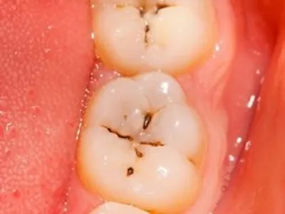 پنج روز مسواک نزدن چه بر سر دهان می‌آورد؟
