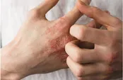 چرا خارش می‌گیریم و راه درمانش چیست؟
