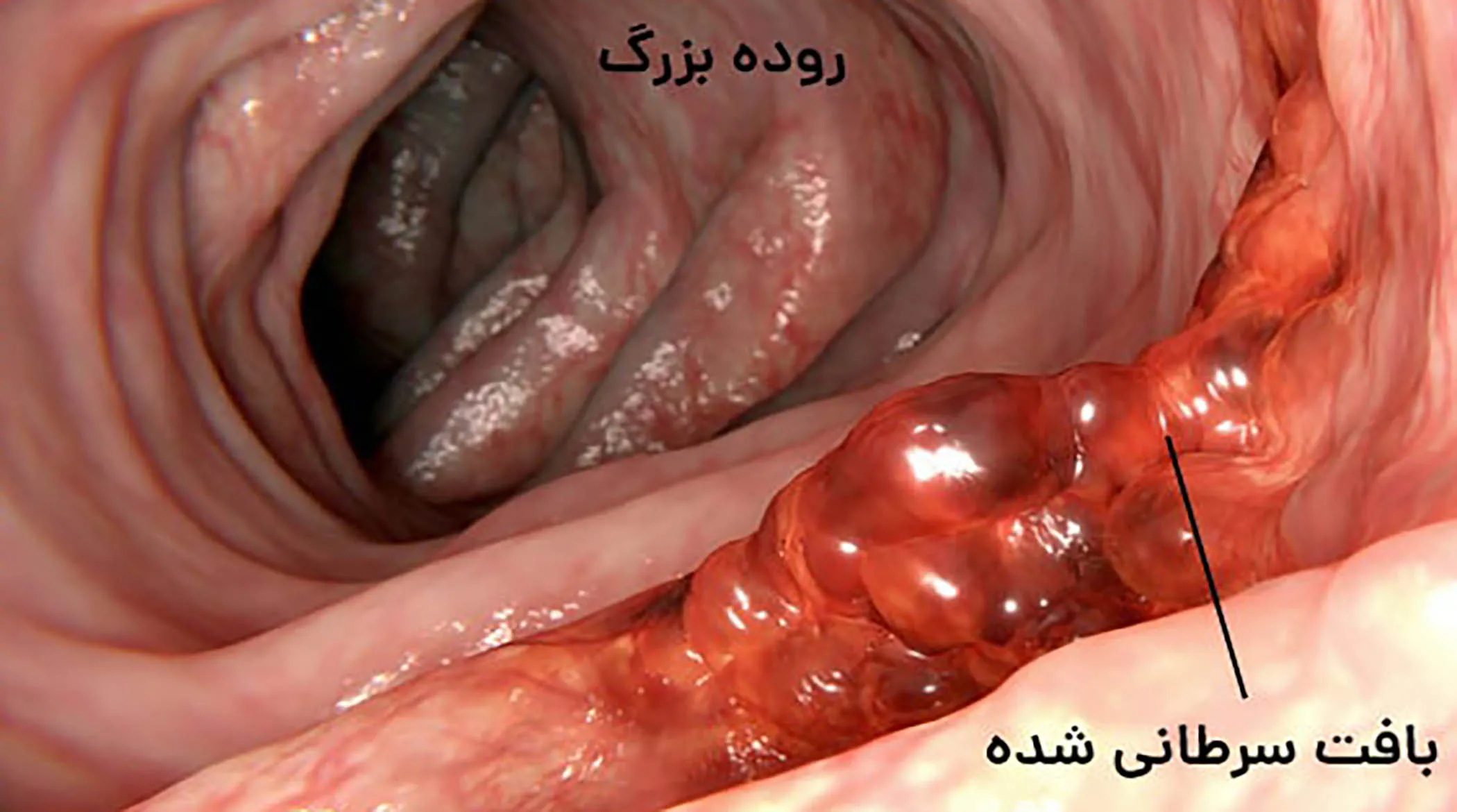 سرطانی شایع در ایران که هیچ علامتی ندارد!