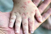 افزایش موارد ابتلا به سرخک در سراسر جهان